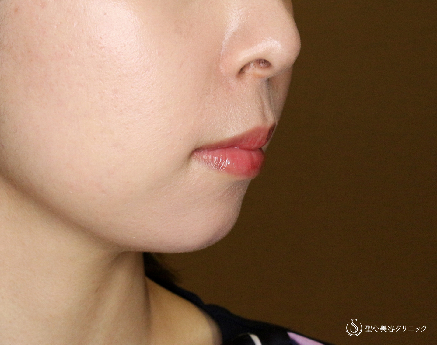 【20代女性・画期的なアゴの注入治療】ヒアルロン酸＆プレミアムPRP皮膚再生療法「ハイブリッド輪郭形成」（直後〜6ヶ月後） After 