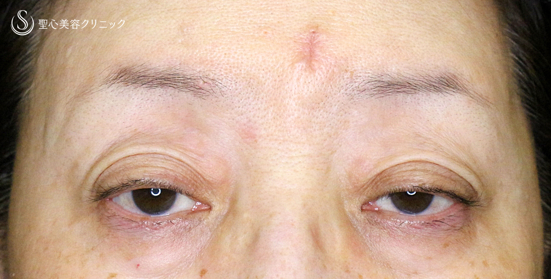 【60代女性・ハードコンタクトによる眼瞼下垂】切らない眼瞼下垂+α法（術直後〜1年後） Before 