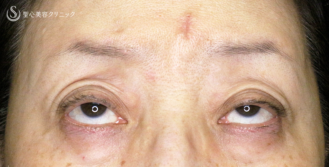 【60代女性・ハードコンタクトによる眼瞼下垂】切らない眼瞼下垂+α法（術直後〜1年後） Before 