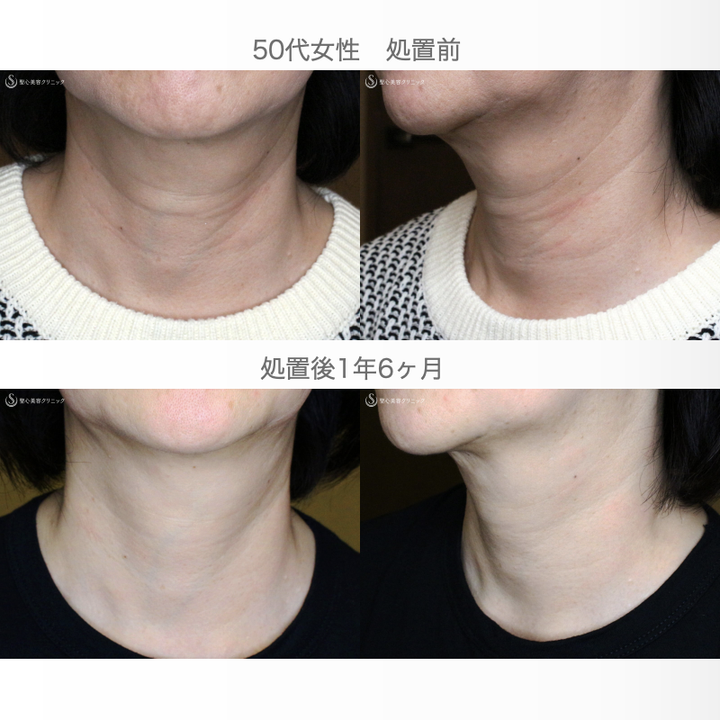 【50代女性・首の横ジワは難しい】プレミアムPRP皮膚再生療法（1年6ヶ月後） After 