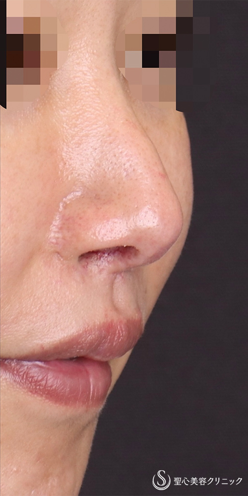 【30代女性・鼻の穴を目立ちにくくしたい！！】鼻孔縁下降術（術後3ヶ月） After 