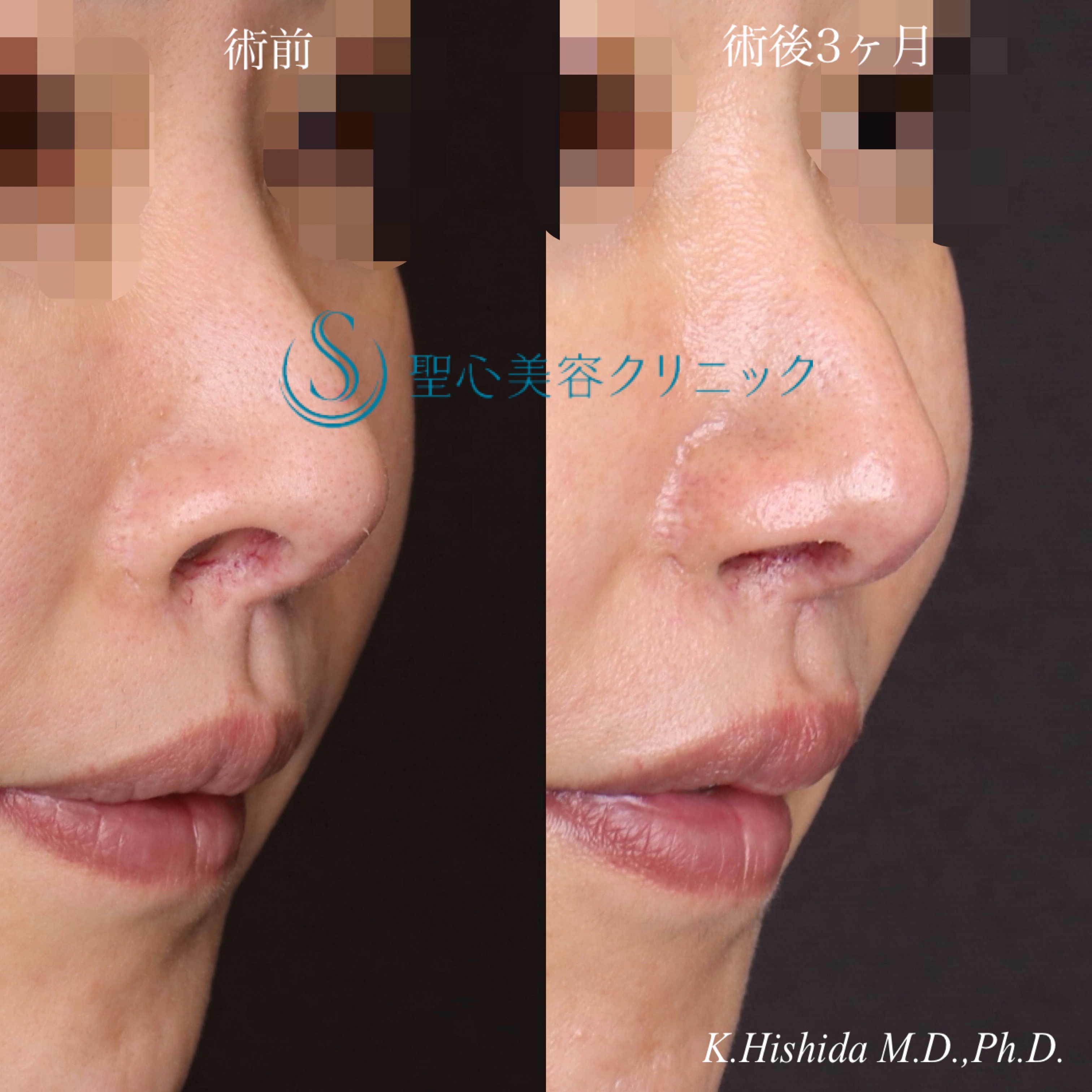 【30代女性・鼻の穴を目立ちにくくしたい！！】鼻孔縁下降術（術後3ヶ月） After 