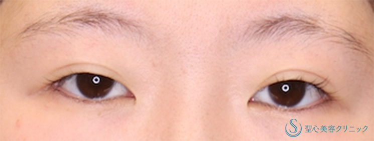 【20代女性・二重切開で目の開きを改善】二重術（切開法）部分切開/全切開（術後1ヶ月） Before 