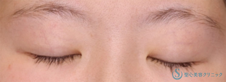 【20代女性・二重切開で目の開きを改善】二重術（切開法）部分切開/全切開（術後1ヶ月） Before 