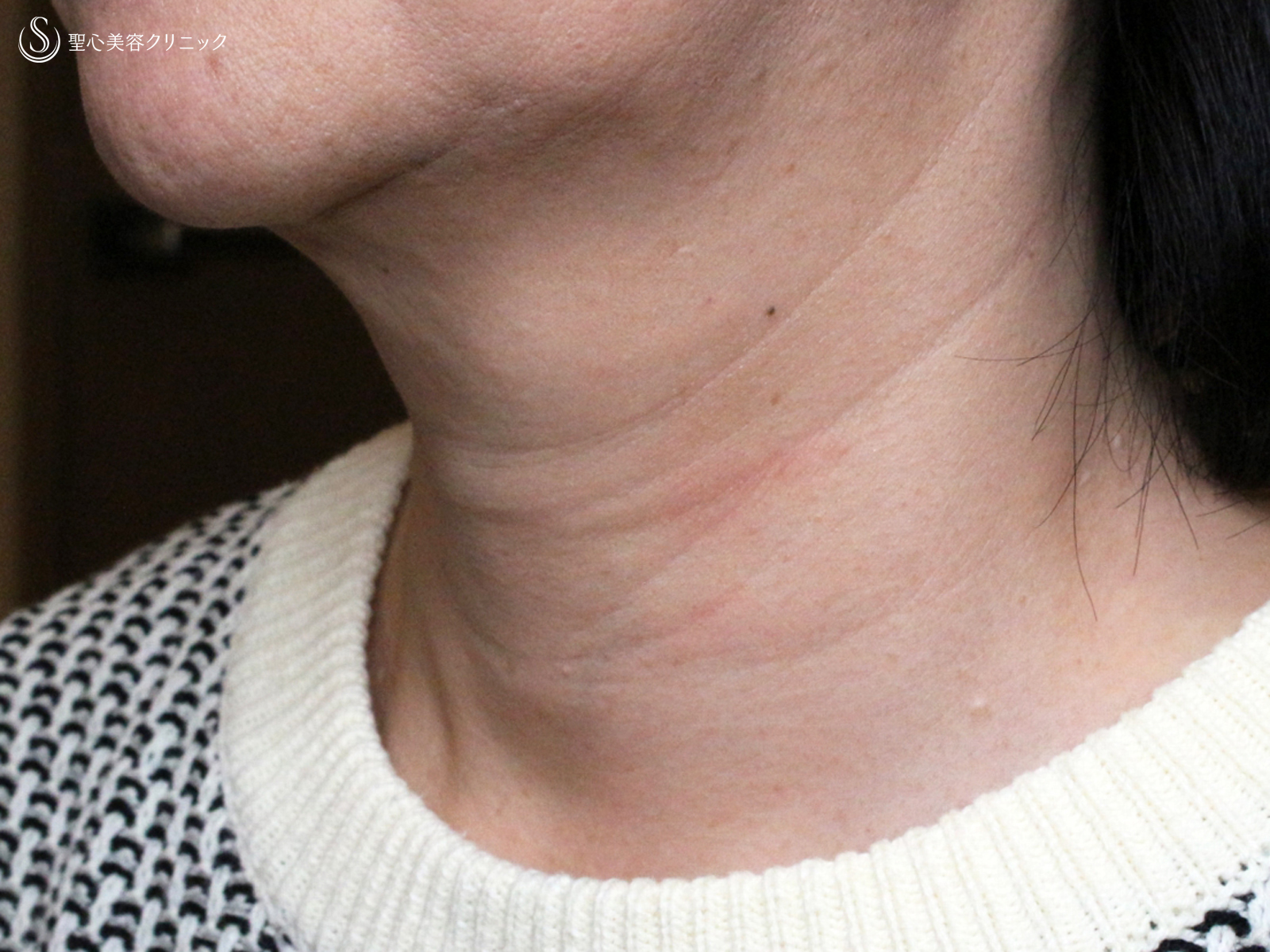 【50代女性・首の横ジワは難しい】プレミアムPRP皮膚再生療法（1年6ヶ月後） Before 