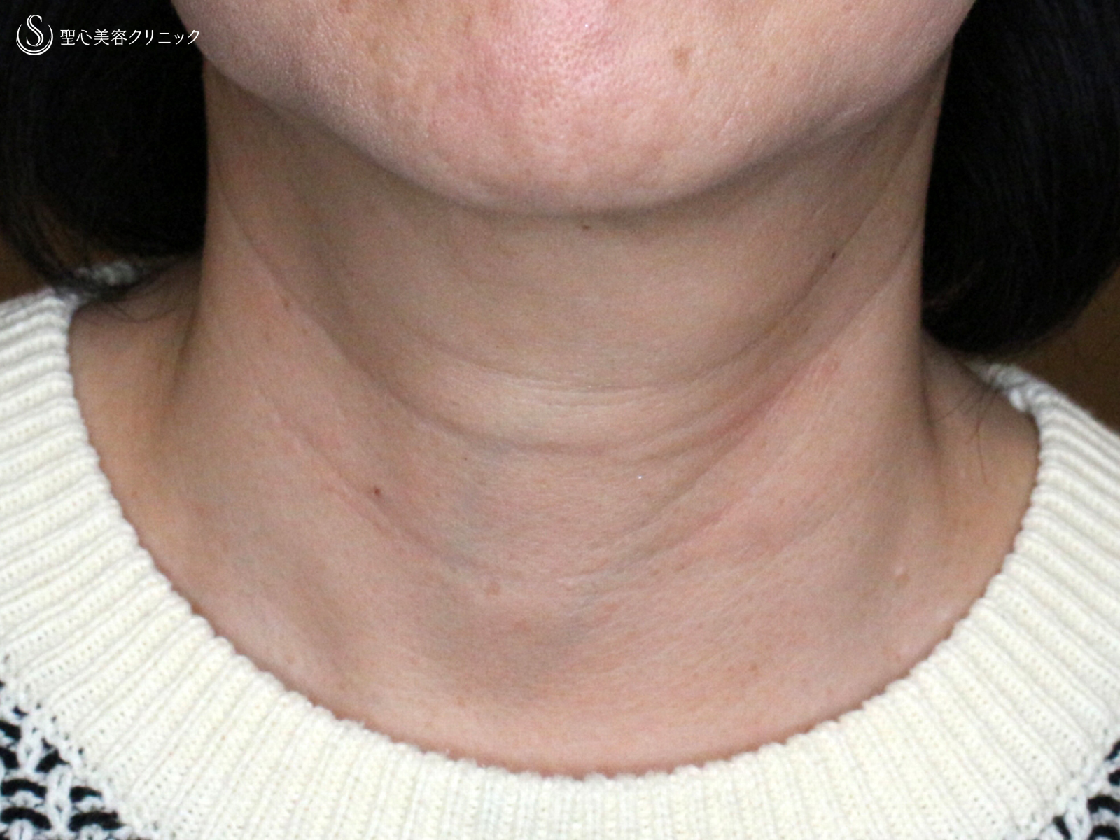 【50代女性・首の横ジワは難しい】プレミアムPRP皮膚再生療法（1年6ヶ月後） Before 