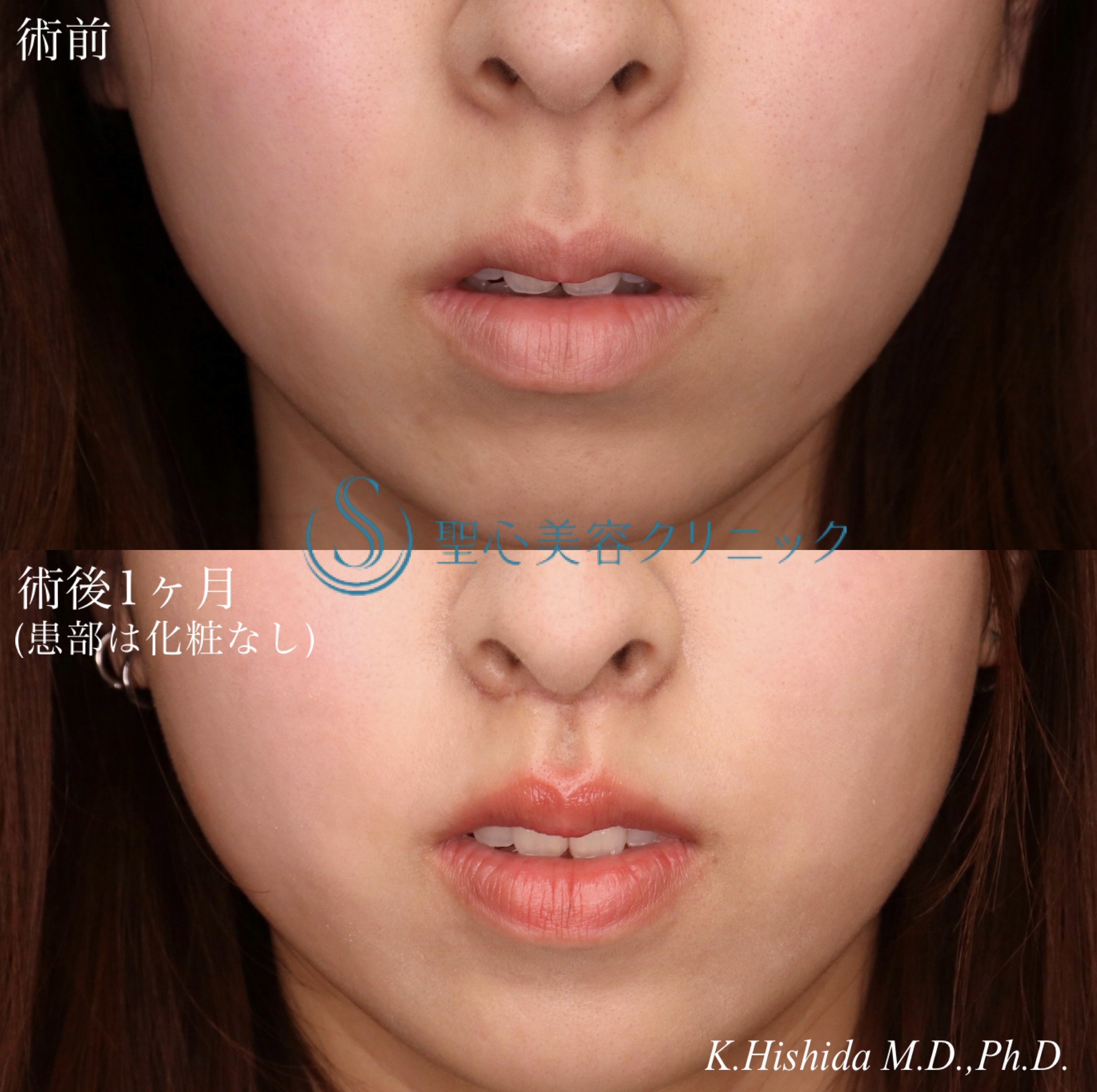 【20代女性・人中をバランスよくできるだけ短くしたい！！】プレミアムリップリフト（プレミアム人中短縮術）（術後1ヶ月） After 