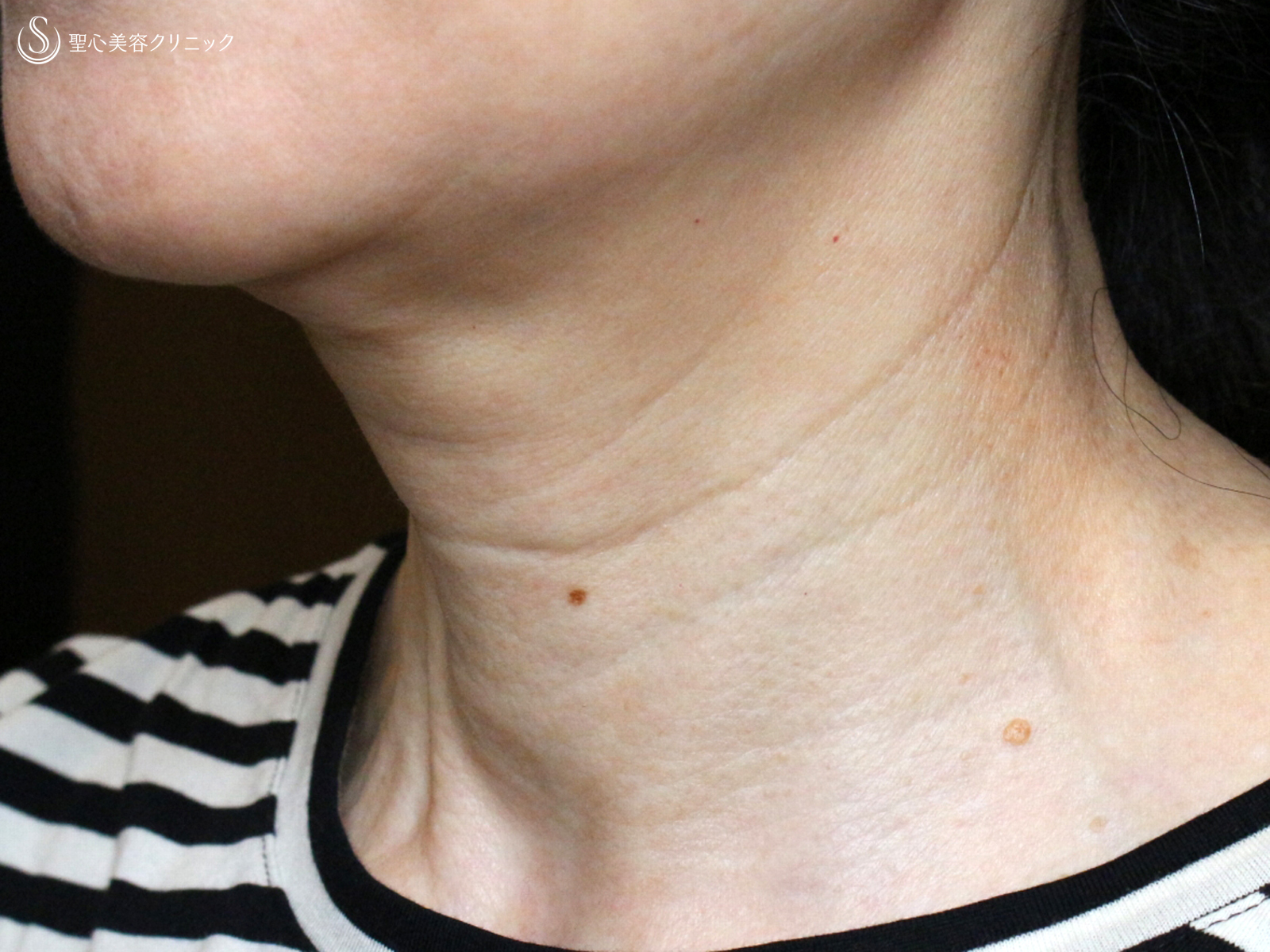 【60代女性・首の横ジワを綺麗に】プレミアムPRP皮膚再生療法（1年後） Before 