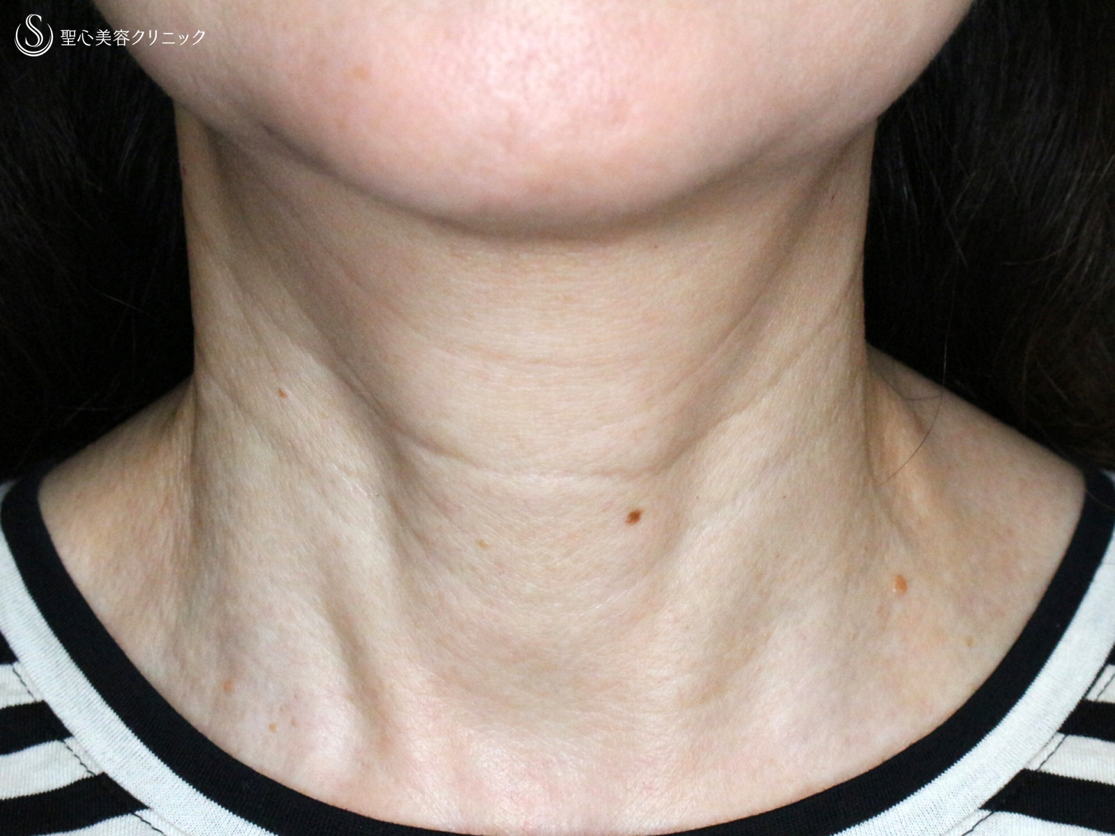 【60代女性・首の横ジワを綺麗に】プレミアムPRP皮膚再生療法（1年後） Before 