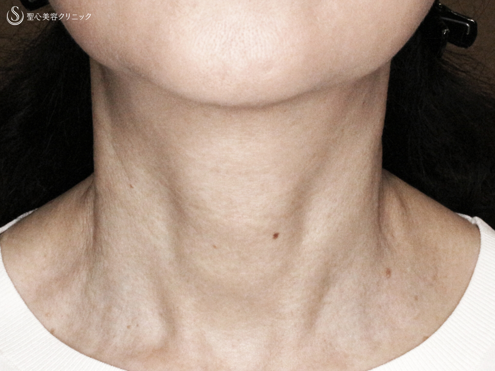 【60代女性・首の横ジワを綺麗に】プレミアムPRP皮膚再生療法（1年後） After 