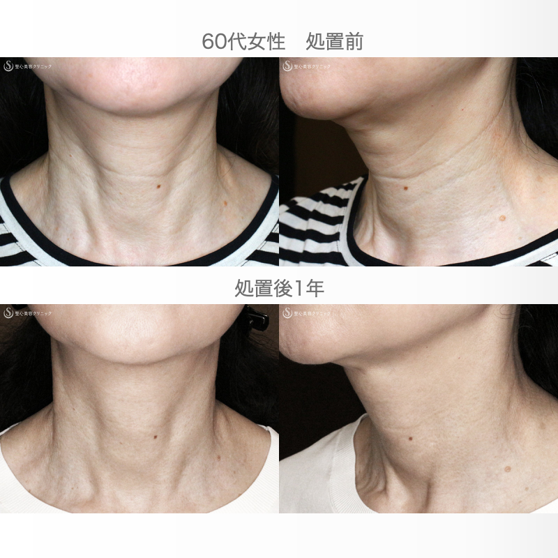【60代女性・首の横ジワを綺麗に】プレミアムPRP皮膚再生療法（1年後） After 