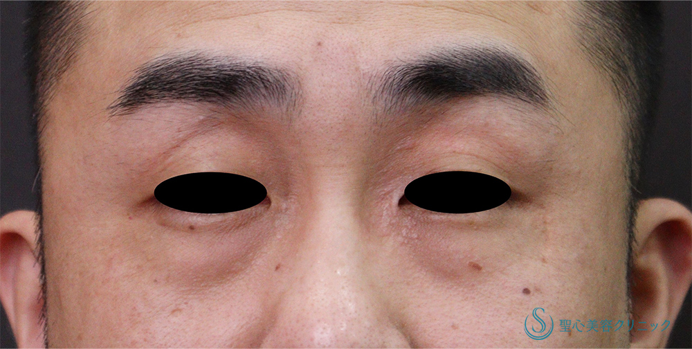 【40代男性・目の下のくま】経結膜下脱脂法（術後1か月） Before 