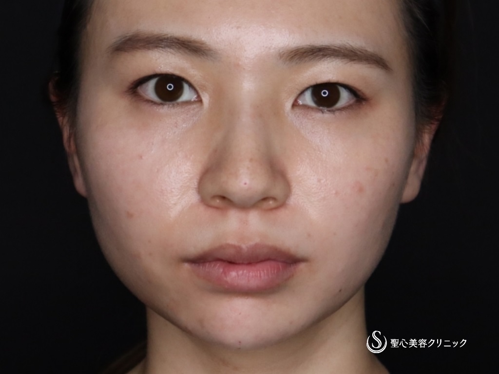 【20代女性・鼻筋を高くして鼻先と顎もヒアルロン酸で整える】ヒアルロン酸注入（注入直後） After 
