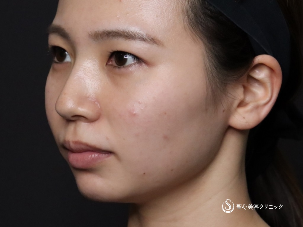 【20代女性・鼻筋を高くして鼻先と顎もヒアルロン酸で整える】ヒアルロン酸注入（注入直後） Before 