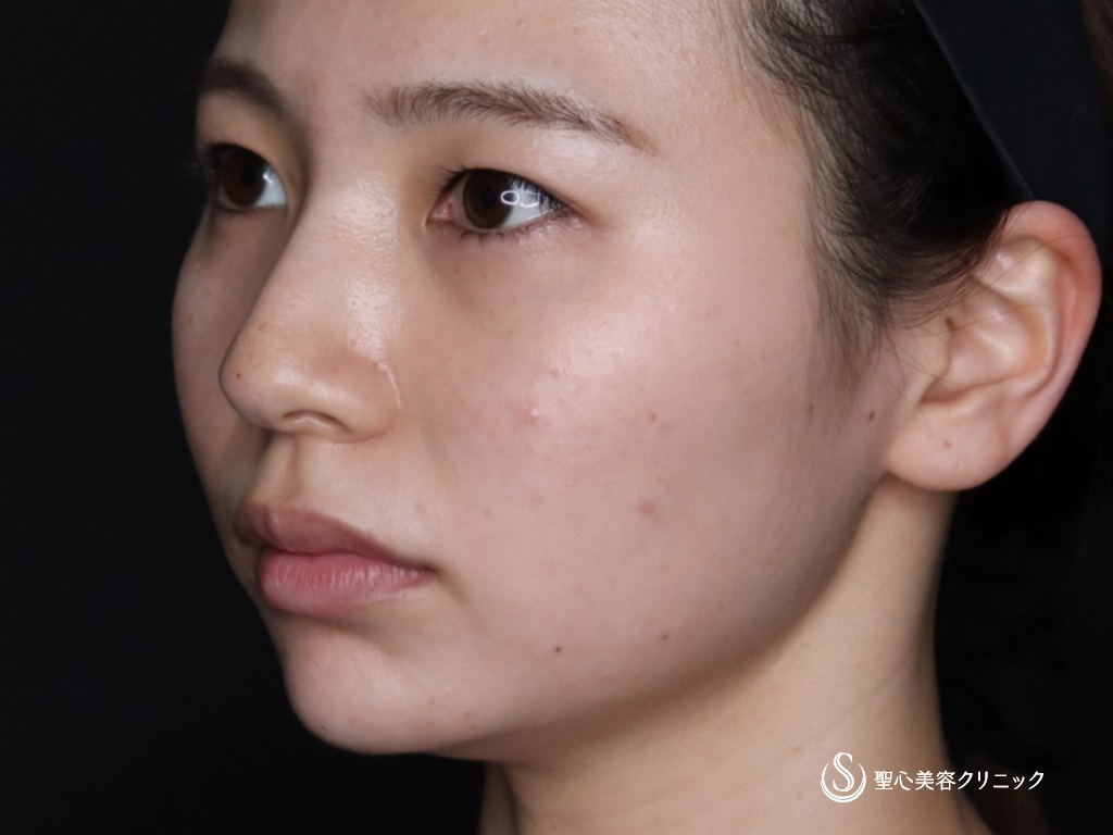 【20代女性・鼻筋を高くして鼻先と顎もヒアルロン酸で整える】ヒアルロン酸注入（注入直後） After 