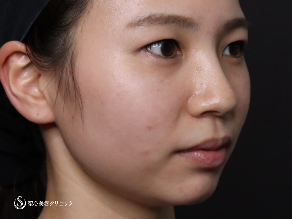 【20代女性・鼻筋を高くして鼻先と顎もヒアルロン酸で整える】ヒアルロン酸注入（注入直後） Before 