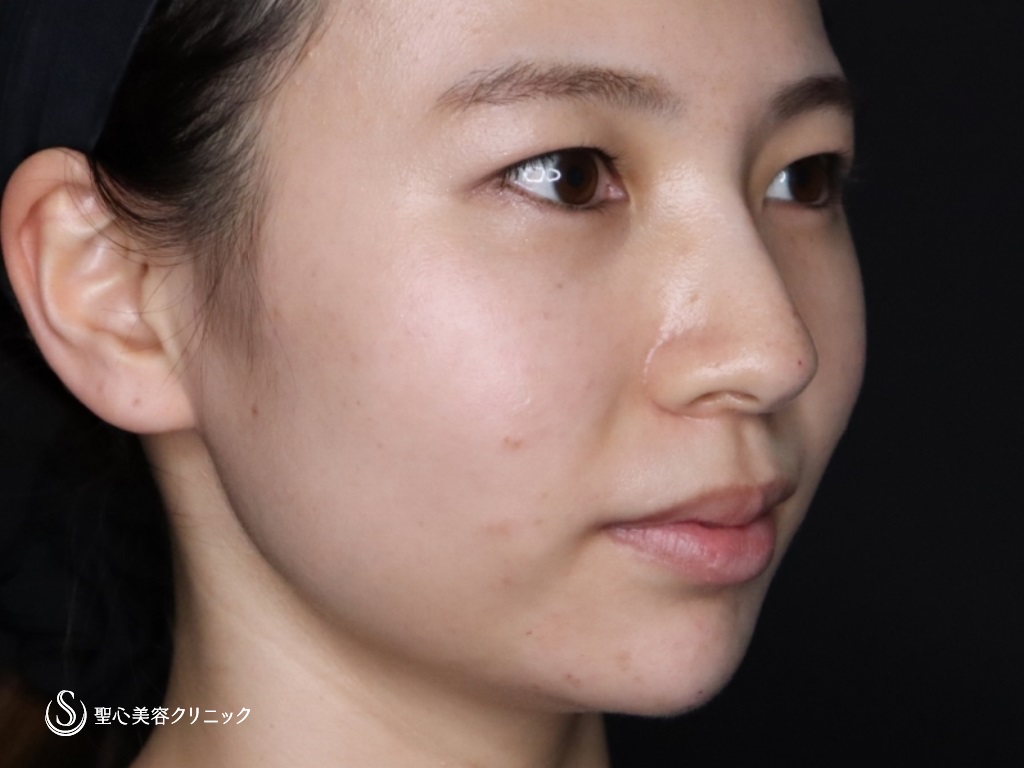 【20代女性・鼻筋を高くして鼻先と顎もヒアルロン酸で整える】ヒアルロン酸注入（注入直後） After 