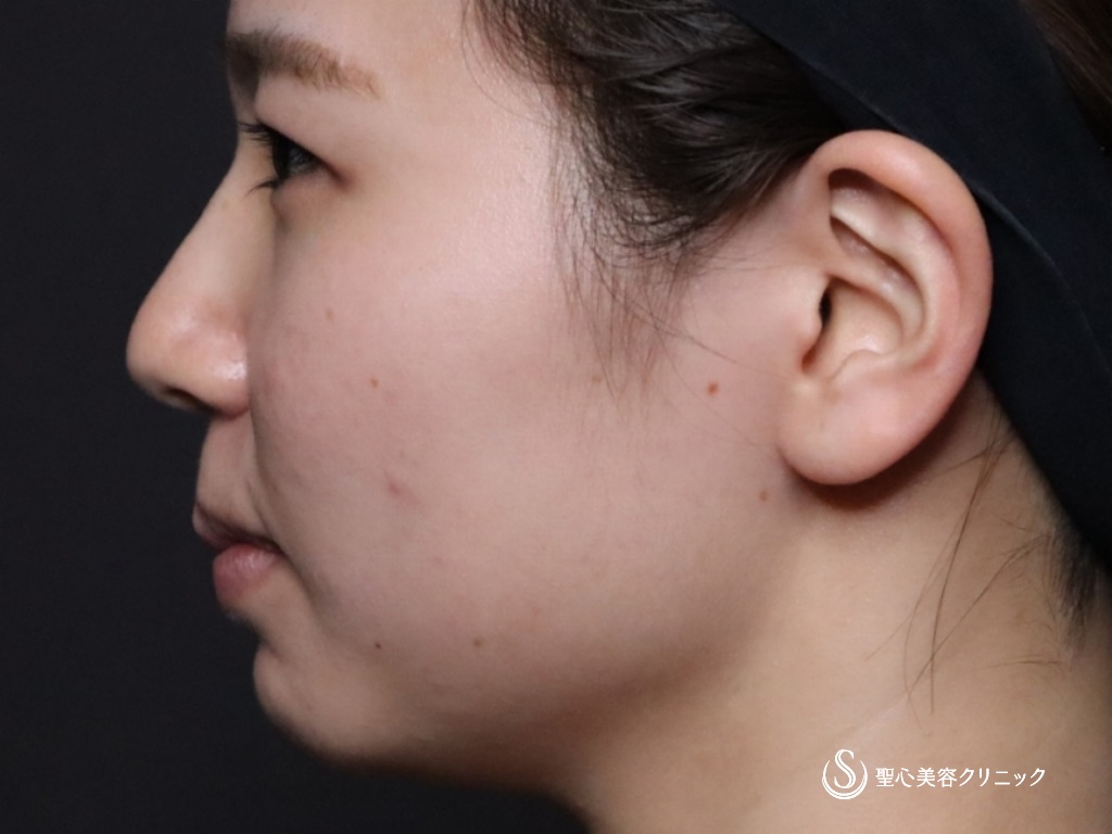 【20代女性・鼻筋を高くして鼻先と顎もヒアルロン酸で整える】ヒアルロン酸注入（注入直後） Before 