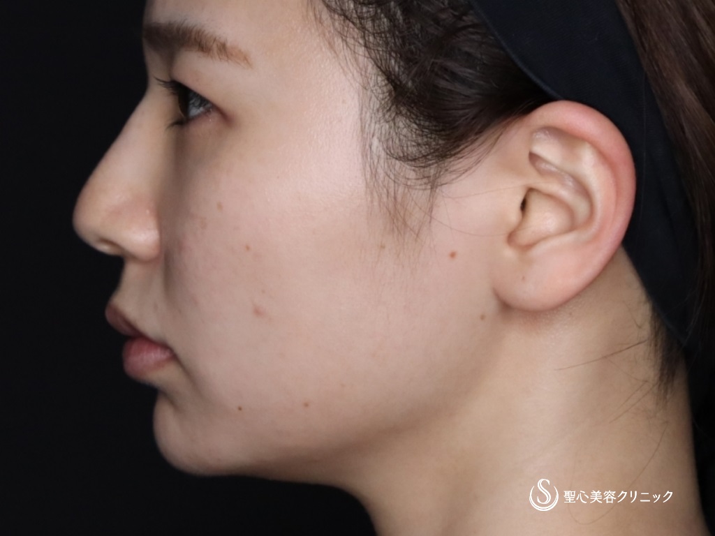 【20代女性・鼻筋を高くして鼻先と顎もヒアルロン酸で整える】ヒアルロン酸注入（注入直後） After 