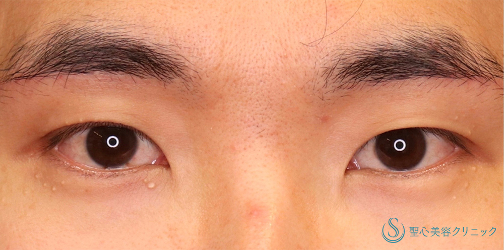 【30代男性・ナチュラルで格好いい二重に！！】マイクロメソッド＋α（3点固定）（術後1ヶ月） Before 