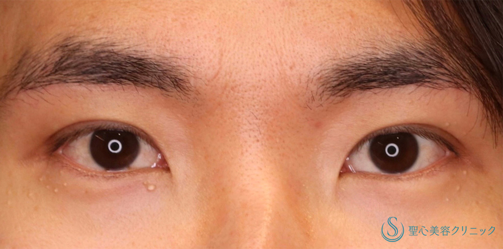 【30代男性・ナチュラルで格好いい二重に！！】マイクロメソッド＋α（3点固定）（術後1ヶ月） After 