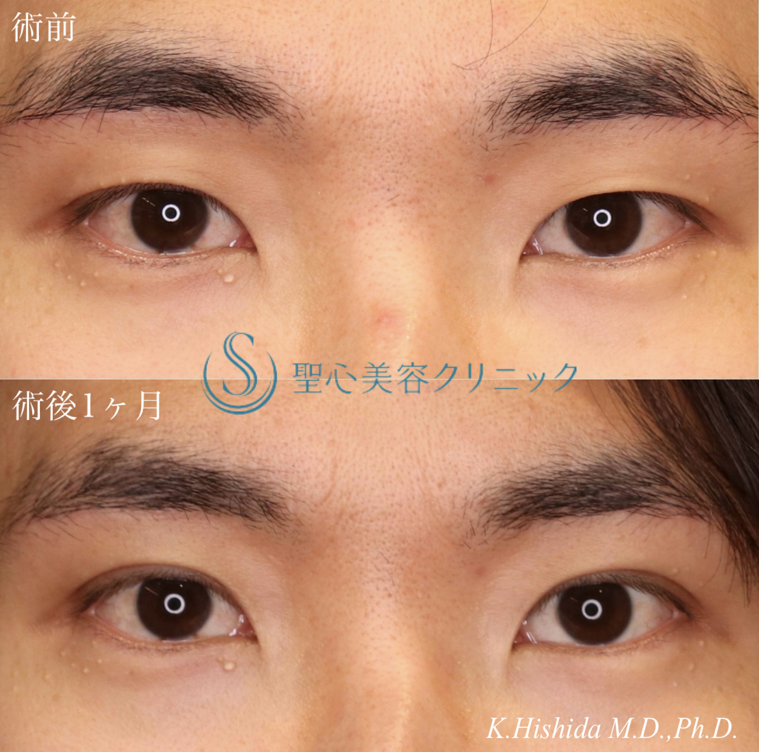 【30代男性・ナチュラルで格好いい二重に！！】マイクロメソッド＋α（3点固定）（術後1ヶ月） After 