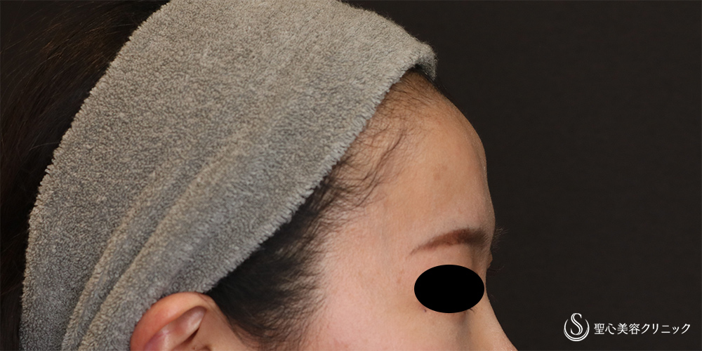【30代女性・女性らしい丸みのある額へ】プレミアムPRP皮膚再生療法（額）（6ヶ月後） Before 