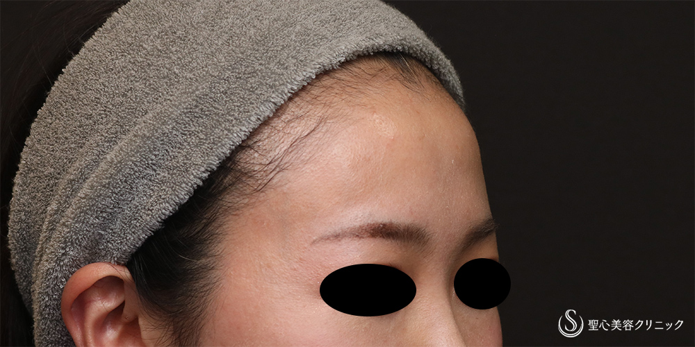 【30代女性・女性らしい丸みのある額へ】プレミアムPRP皮膚再生療法（額）（6ヶ月後） Before 
