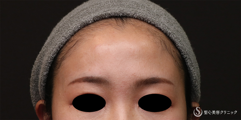 【30代女性・女性らしい丸みのある額へ】プレミアムPRP皮膚再生療法（額）（6ヶ月後） Before 
