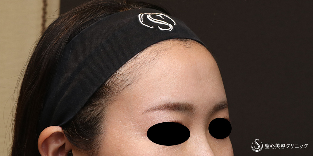 【30代女性・女性らしい丸みのある額へ】プレミアムPRP皮膚再生療法（額）（6ヶ月後） After 