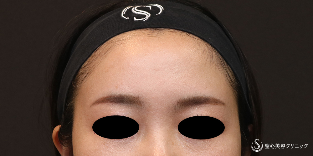 【30代女性・女性らしい丸みのある額へ】プレミアムPRP皮膚再生療法（額）（6ヶ月後） After 
