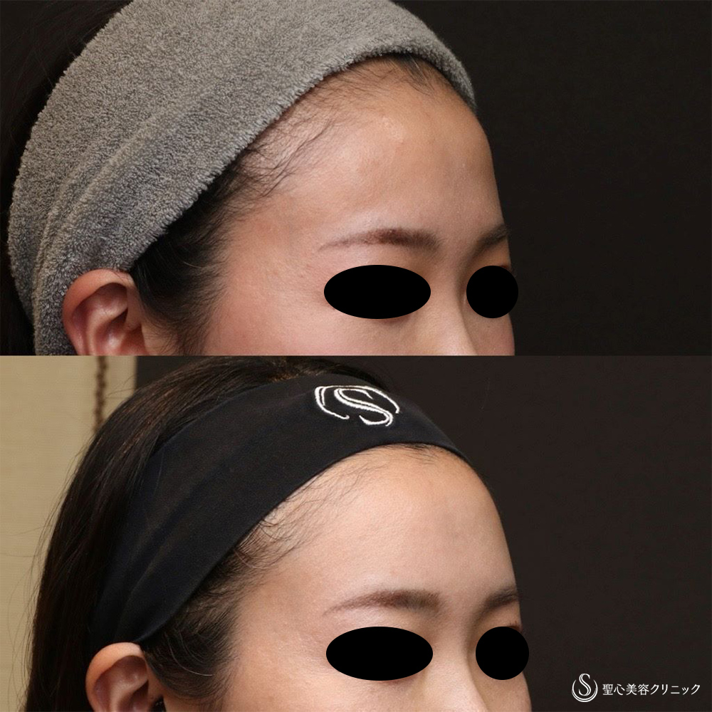 【30代女性・女性らしい丸みのある額へ】プレミアムPRP皮膚再生療法（額）（6ヶ月後） After 