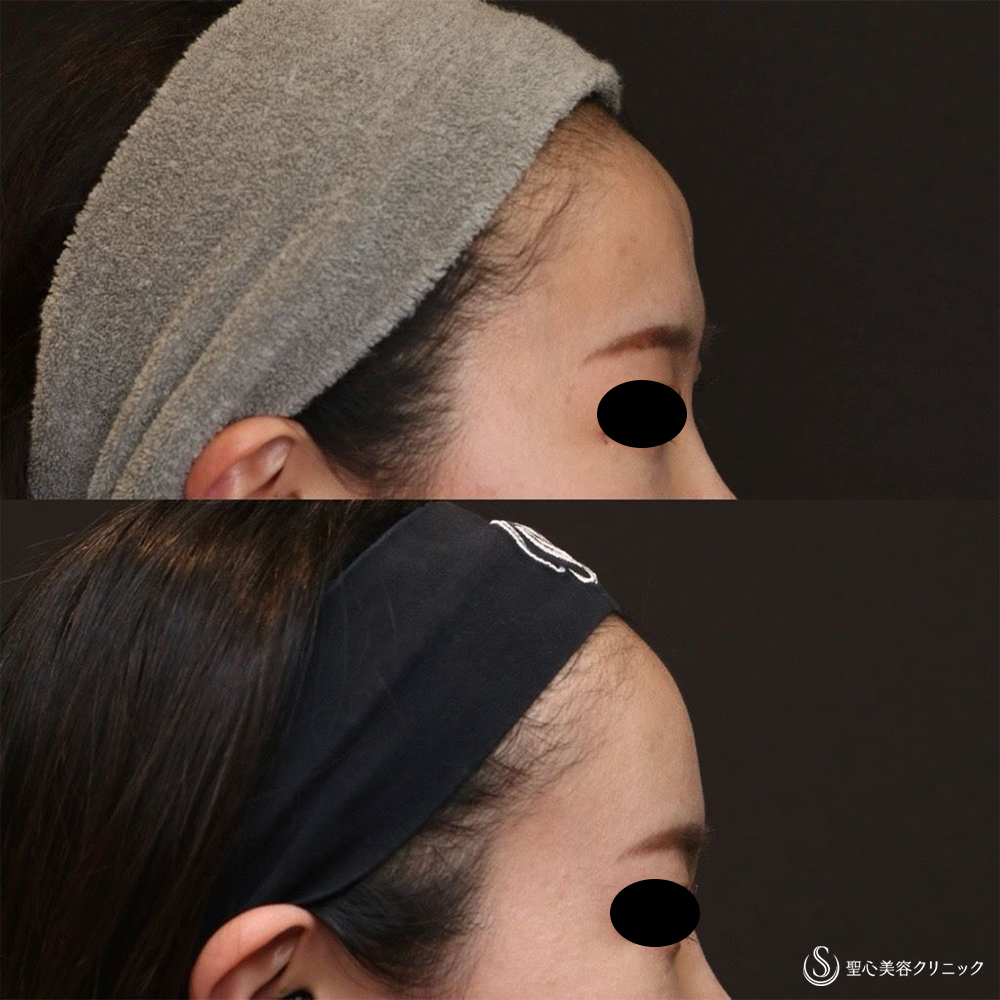 【30代女性・女性らしい丸みのある額へ】プレミアムPRP皮膚再生療法（額）（6ヶ月後） After 