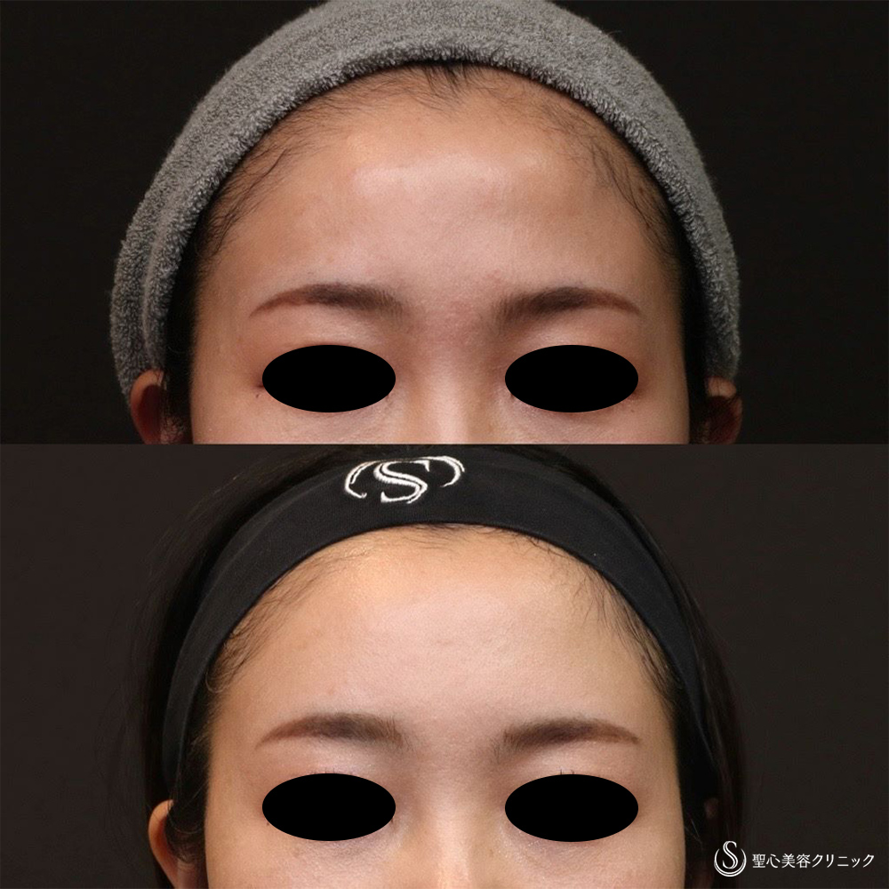 【30代女性・女性らしい丸みのある額へ】プレミアムPRP皮膚再生療法（額）（6ヶ月後） After 