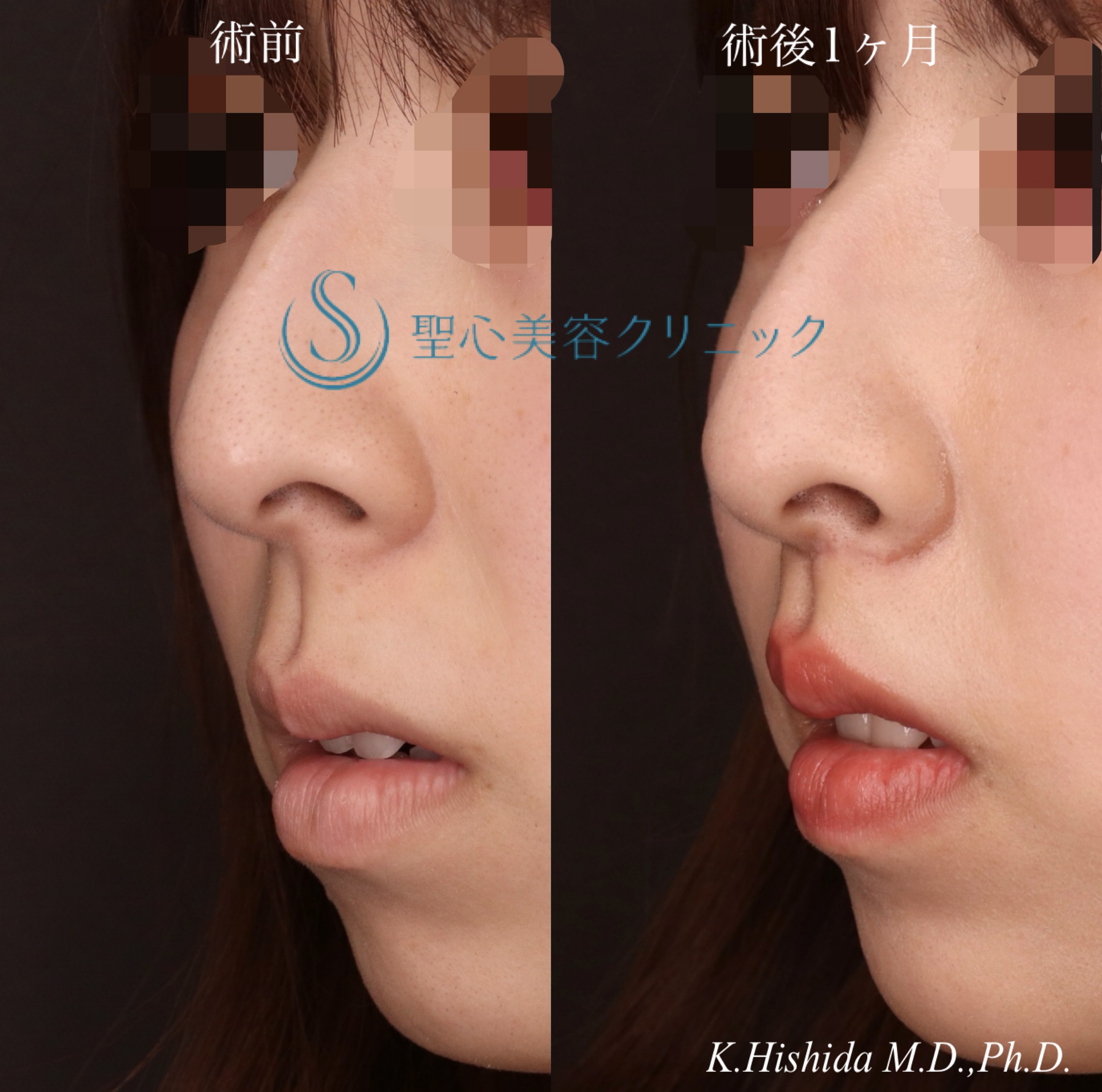 【20代女性・人中をバランスよくできるだけ短くしたい！！】プレミアムリップリフト（プレミアム人中短縮術）（術後1ヶ月） After 