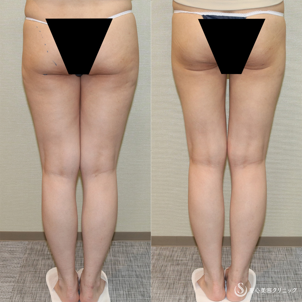 【40代女性・足を細く長く】ベイザーリポ脂肪吸引（大腿全周・臀部）（1ヶ月後） After 