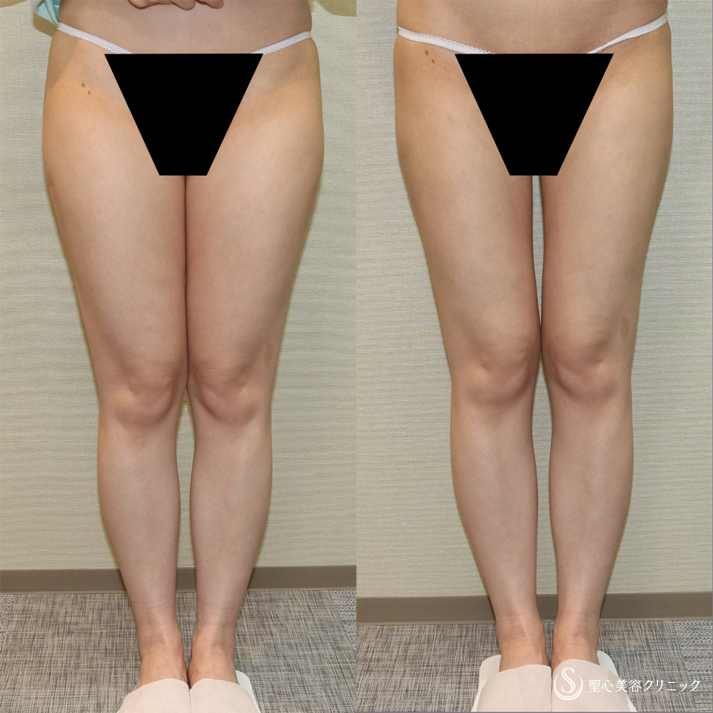 【40代女性・足を細く長く】ベイザーリポ脂肪吸引（大腿全周・臀部）（1ヶ月後） After 