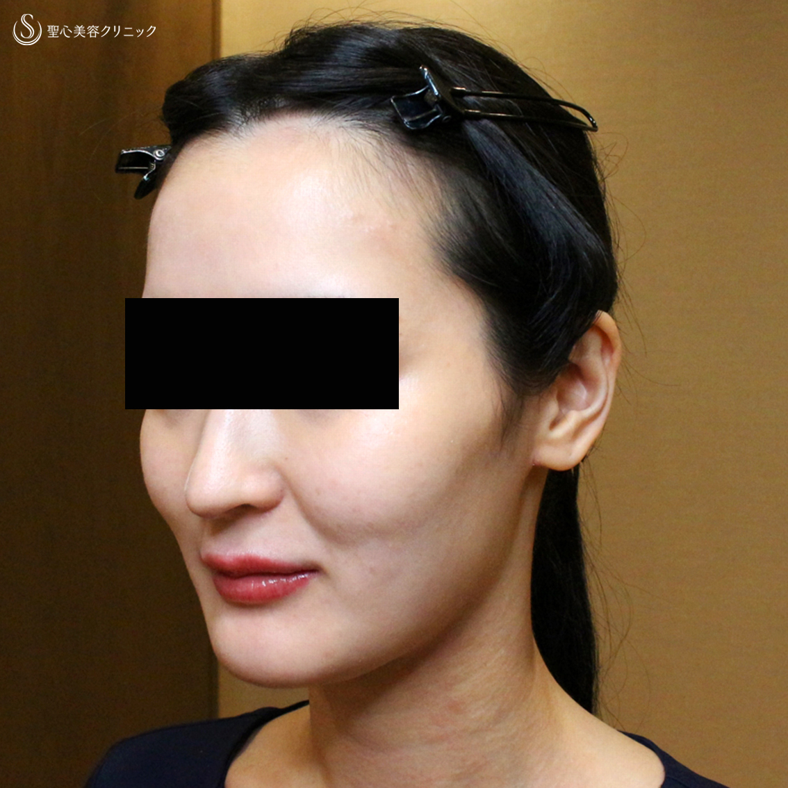 【20代女性・貴族注射＆ホホの凹み治療】プレミアムPRP皮膚再生療法（翌日〜6ヶ月後） Before 
