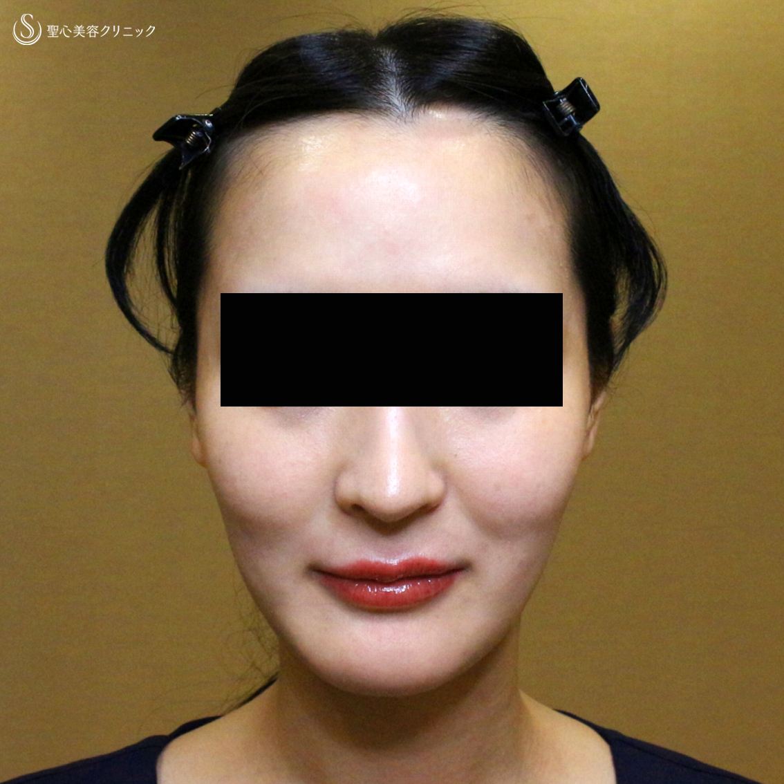【20代女性・貴族注射＆ホホの凹み治療】プレミアムPRP皮膚再生療法（翌日〜6ヶ月後） Before 