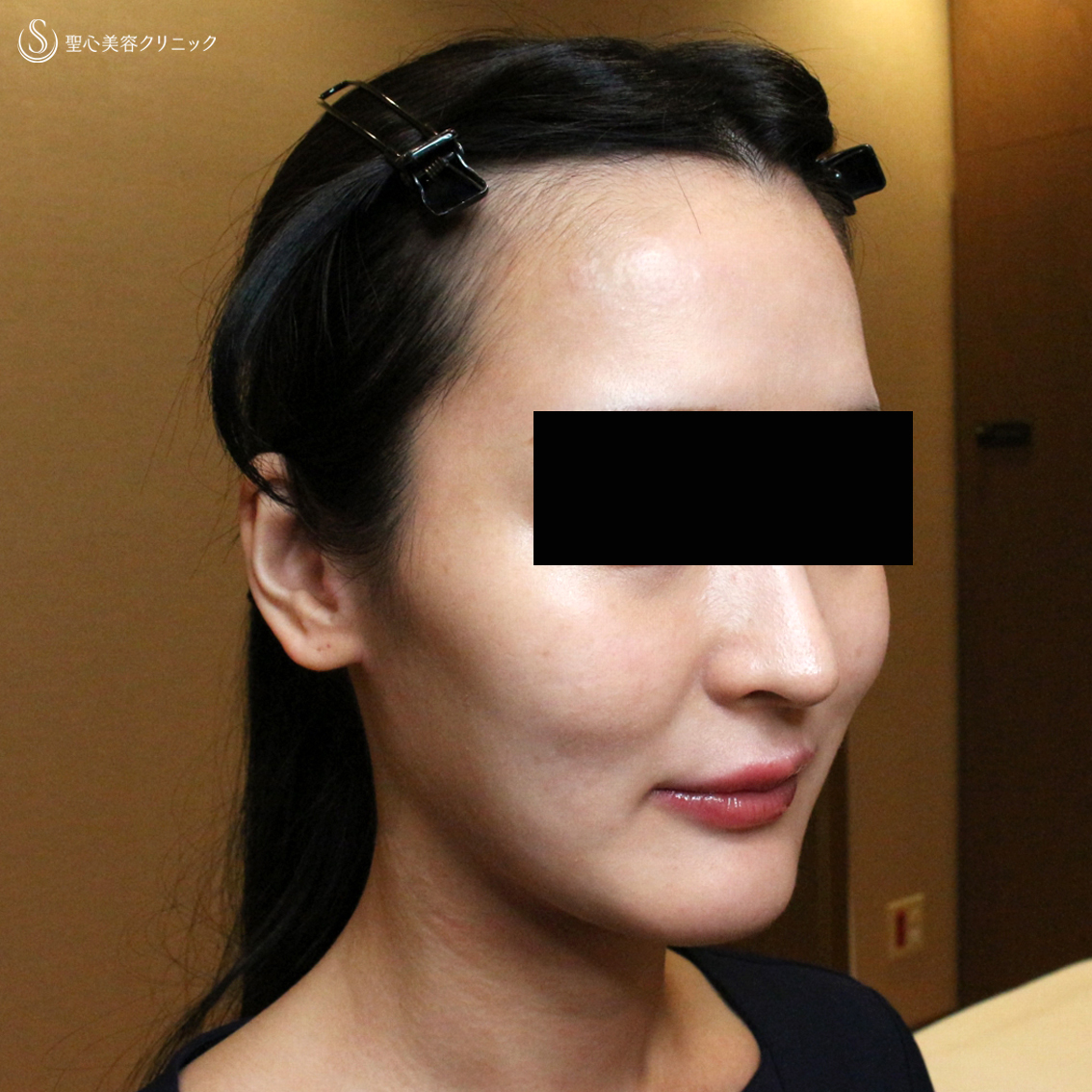 【20代女性・貴族注射＆ホホの凹み治療】プレミアムPRP皮膚再生療法（翌日〜6ヶ月後） Before 