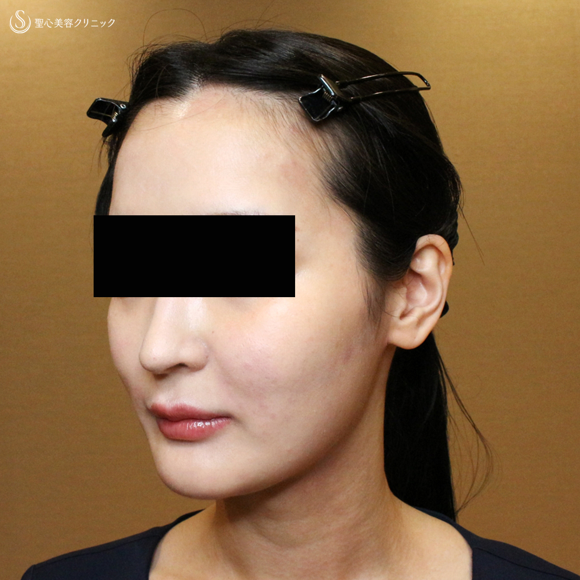 【20代女性・貴族注射＆ホホの凹み治療】プレミアムPRP皮膚再生療法（翌日〜6ヶ月後） Before 