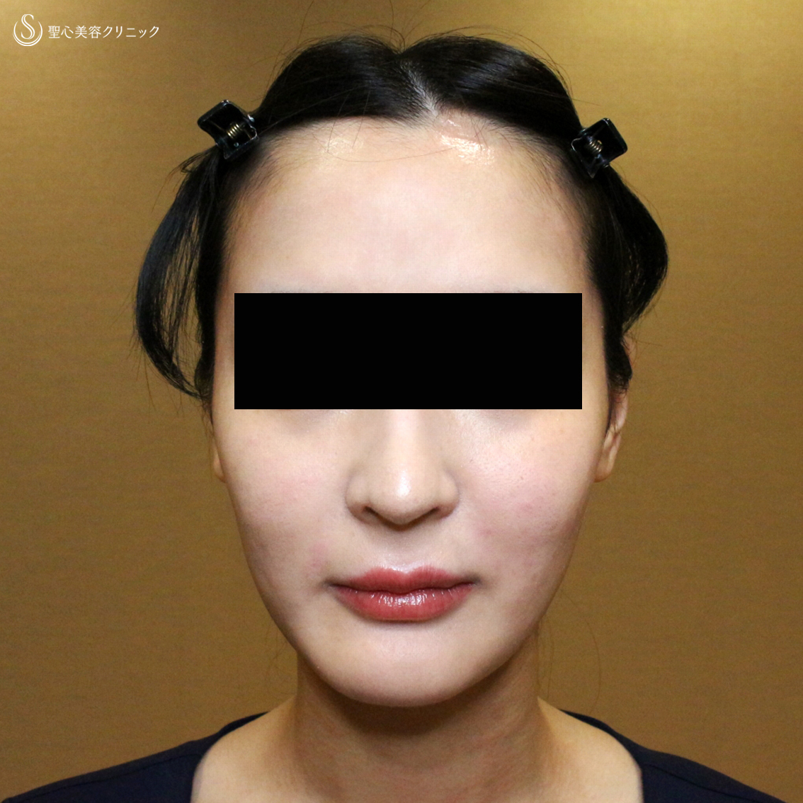 【20代女性・貴族注射＆ホホの凹み治療】プレミアムPRP皮膚再生療法（翌日〜6ヶ月後） Before 