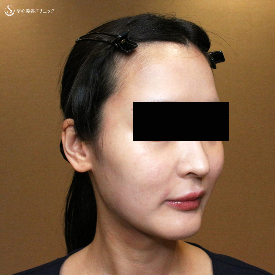 【20代女性・貴族注射＆ホホの凹み治療】プレミアムPRP皮膚再生療法（翌日〜6ヶ月後） Before 