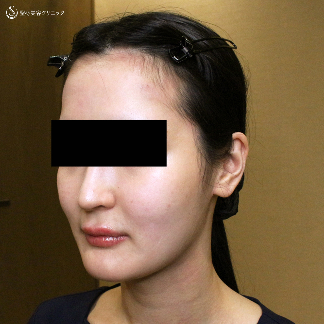 【20代女性・貴族注射＆ホホの凹み治療】プレミアムPRP皮膚再生療法（翌日〜6ヶ月後） After 