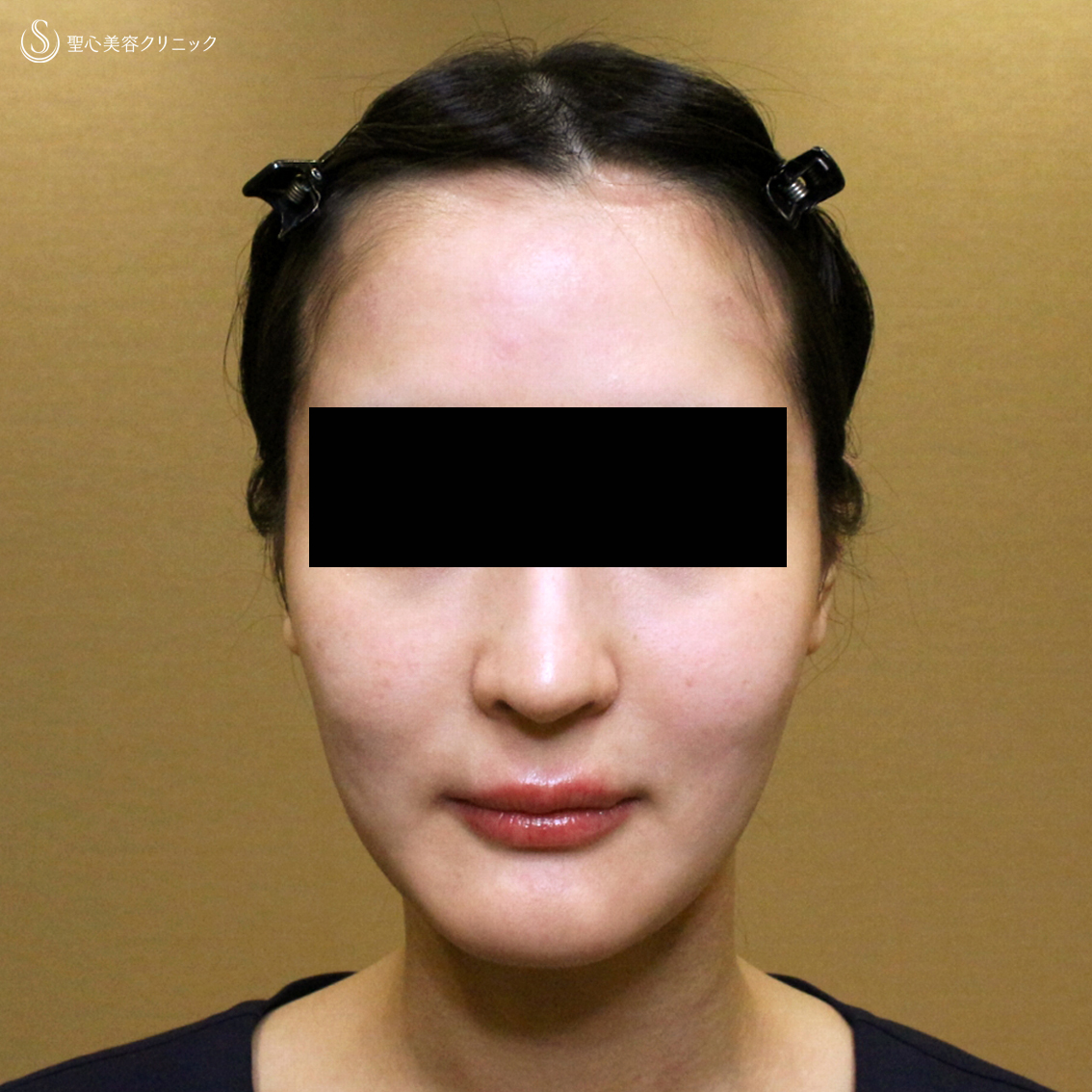 【20代女性・貴族注射＆ホホの凹み治療】プレミアムPRP皮膚再生療法（翌日〜6ヶ月後） After 