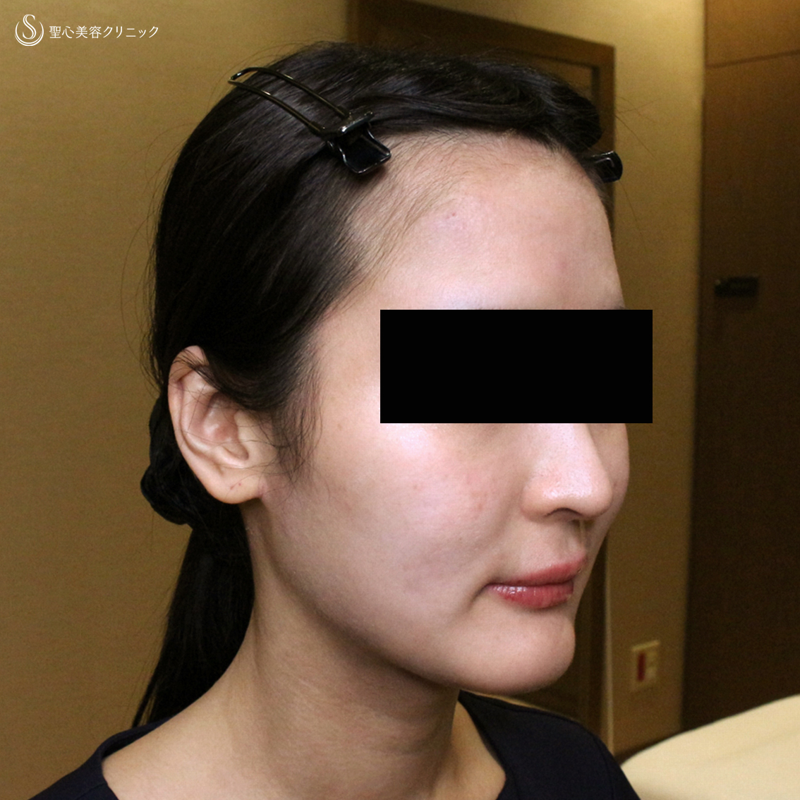 【20代女性・貴族注射＆ホホの凹み治療】プレミアムPRP皮膚再生療法（翌日〜6ヶ月後） After 
