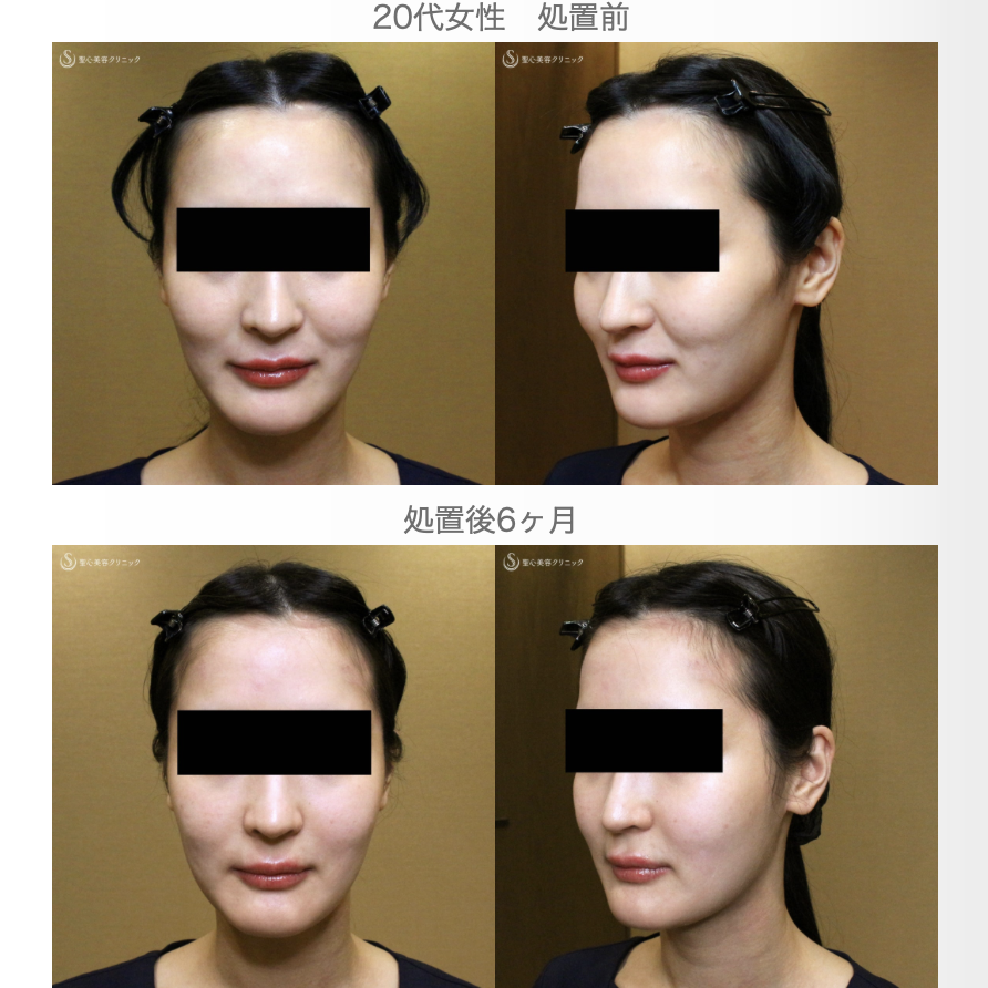 【20代女性・貴族注射＆ホホの凹み治療】プレミアムPRP皮膚再生療法（翌日〜6ヶ月後） After 