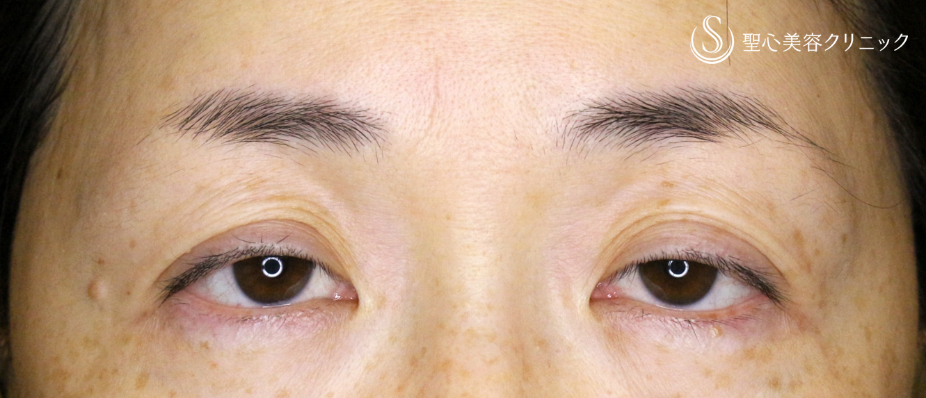 【40代女性・ハードコンタクトによる眼瞼下垂】切らない眼瞼下垂+α法（術直後） Before 