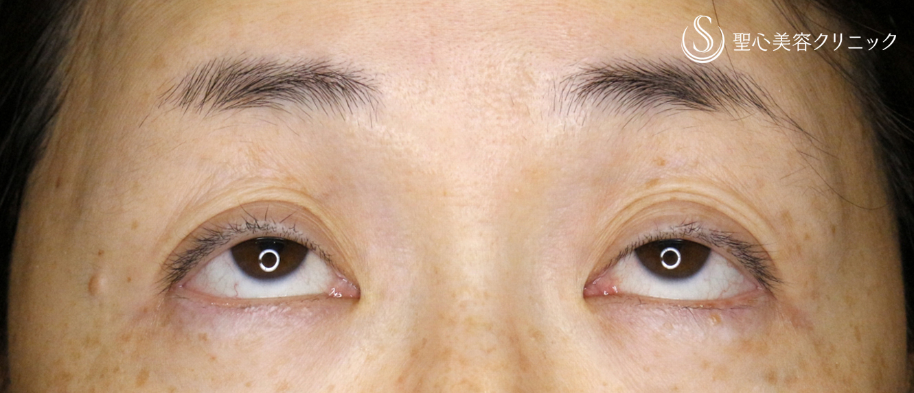 【40代女性・ハードコンタクトによる眼瞼下垂】切らない眼瞼下垂+α法（術直後） Before 