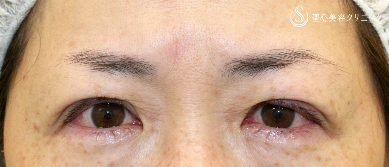 【40代女性・ハードコンタクトによる眼瞼下垂】切らない眼瞼下垂+α法（術直後） After 